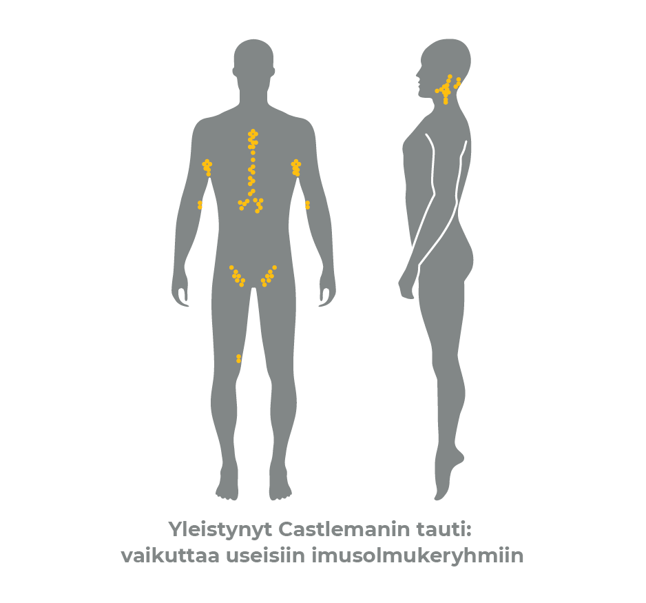 Multicentric Castleman disease